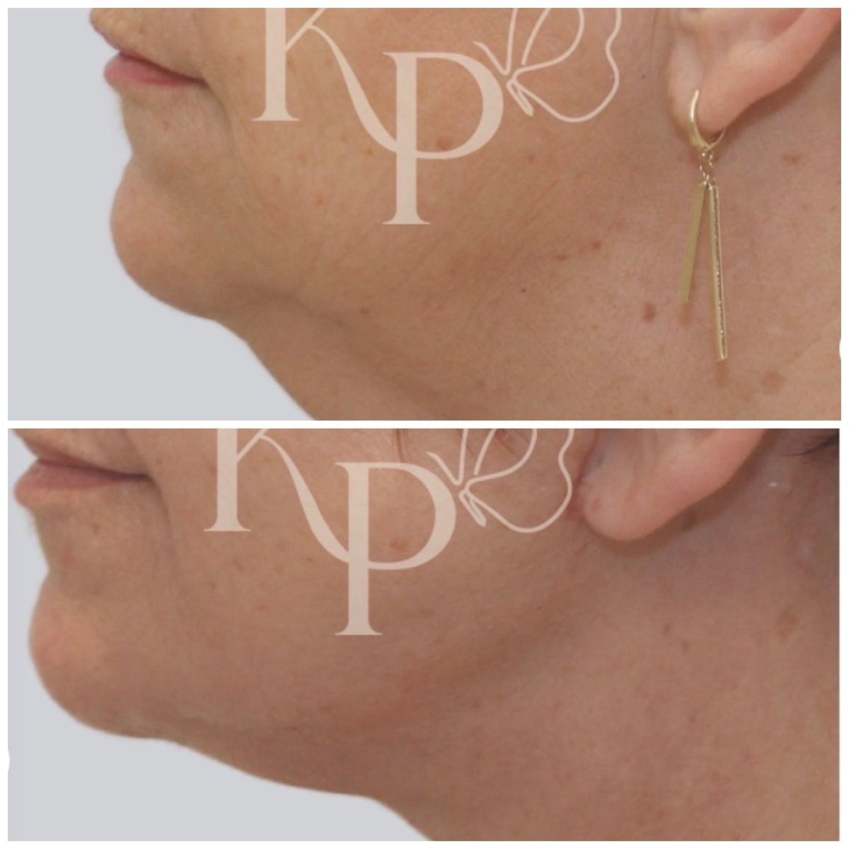 Résultats lifting visage avant/après à Klinika Promedion – contour mâchoire et cou amélioré