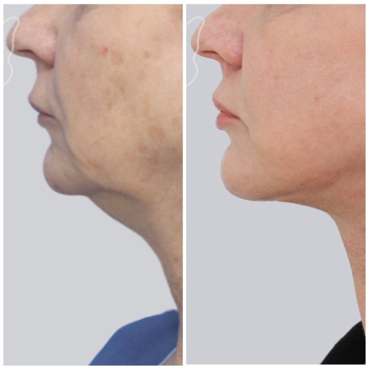 Facelift Vorher-Nachher-Ergebnis bei Klinika Promedion, straffere Kinn- und Halspartie