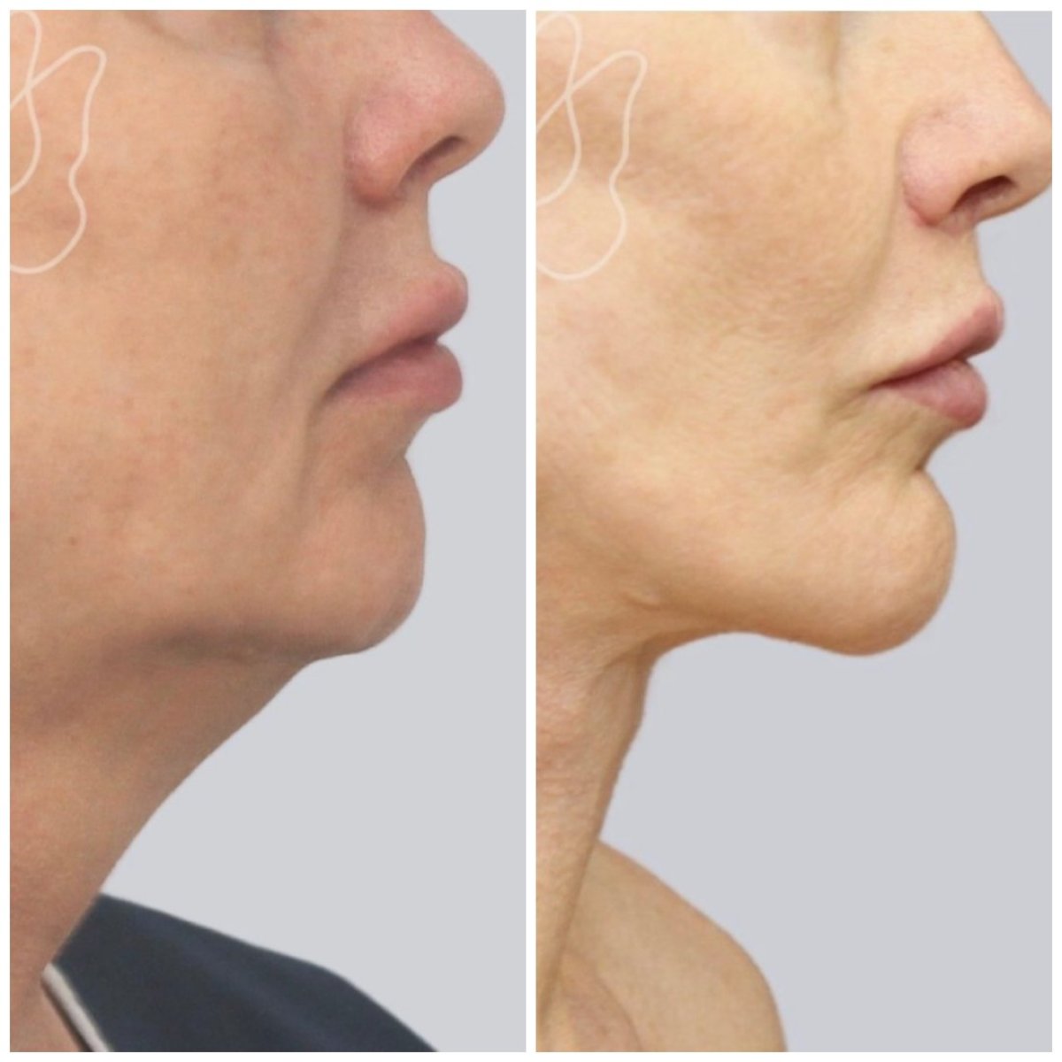 Resultados de lifting facial antes y después en Klinika Promedion, mejor contorno mandibular