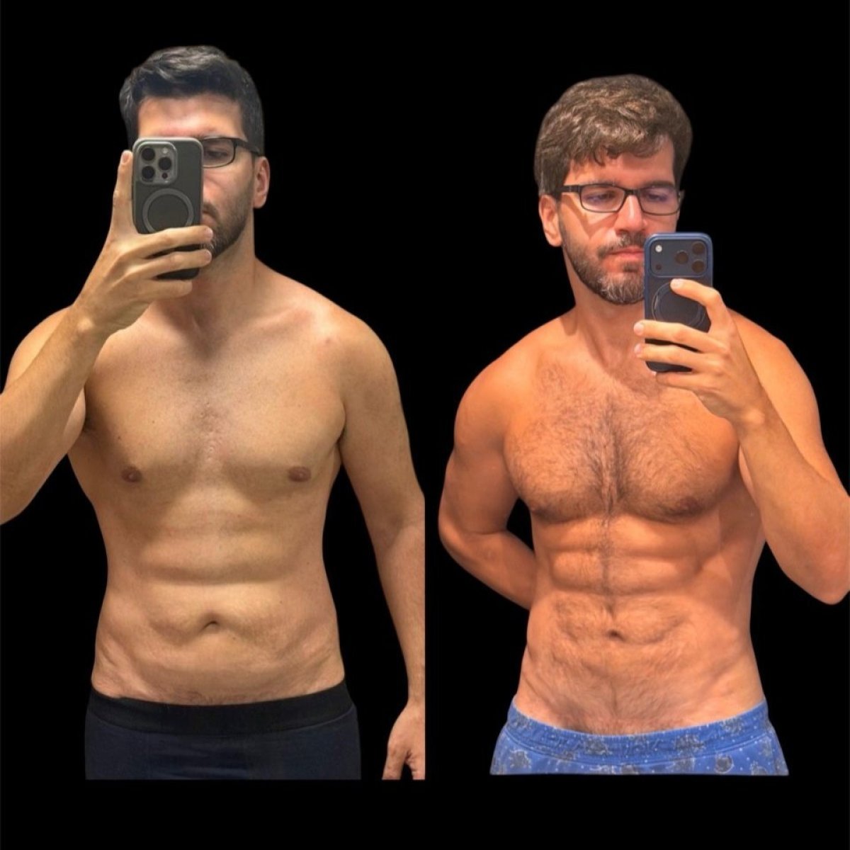 نتائج شفط دهون البطن قبل وبعد في عيادة Dr. Michel Salameh - Plastic And Aesthetic Surgery