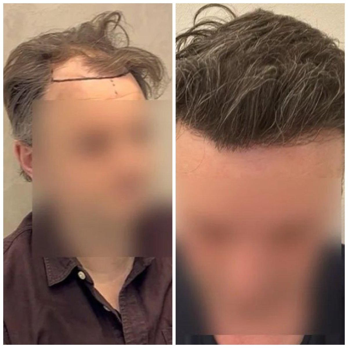 Before and after hair transplant results at Medeks Hair Center – restored natural hairline