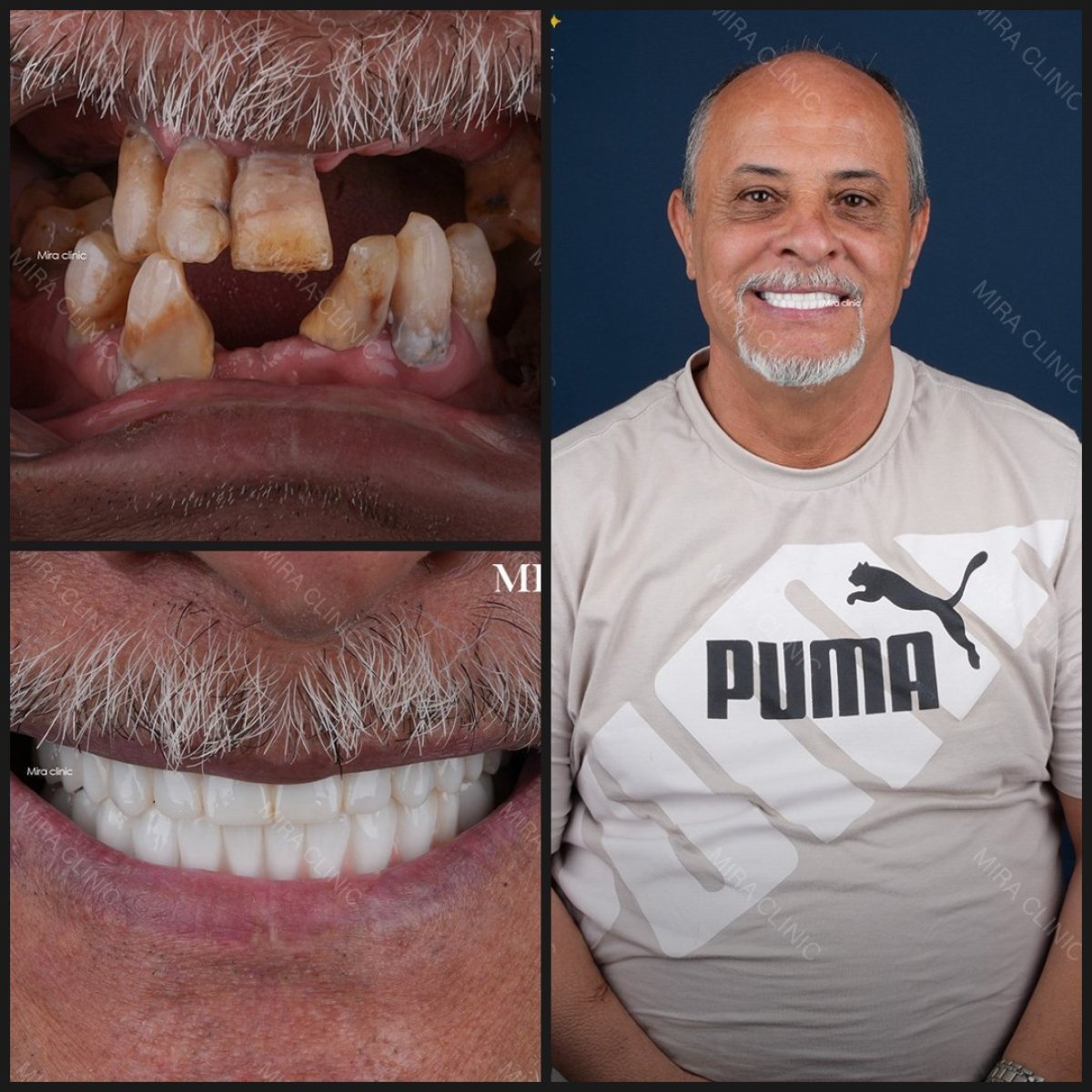 Resultados antes y después de implantes dentales All-on-6 en Dental Clinic Mira Clinic SAĞLIK TURİZM ŞİRKETİ
