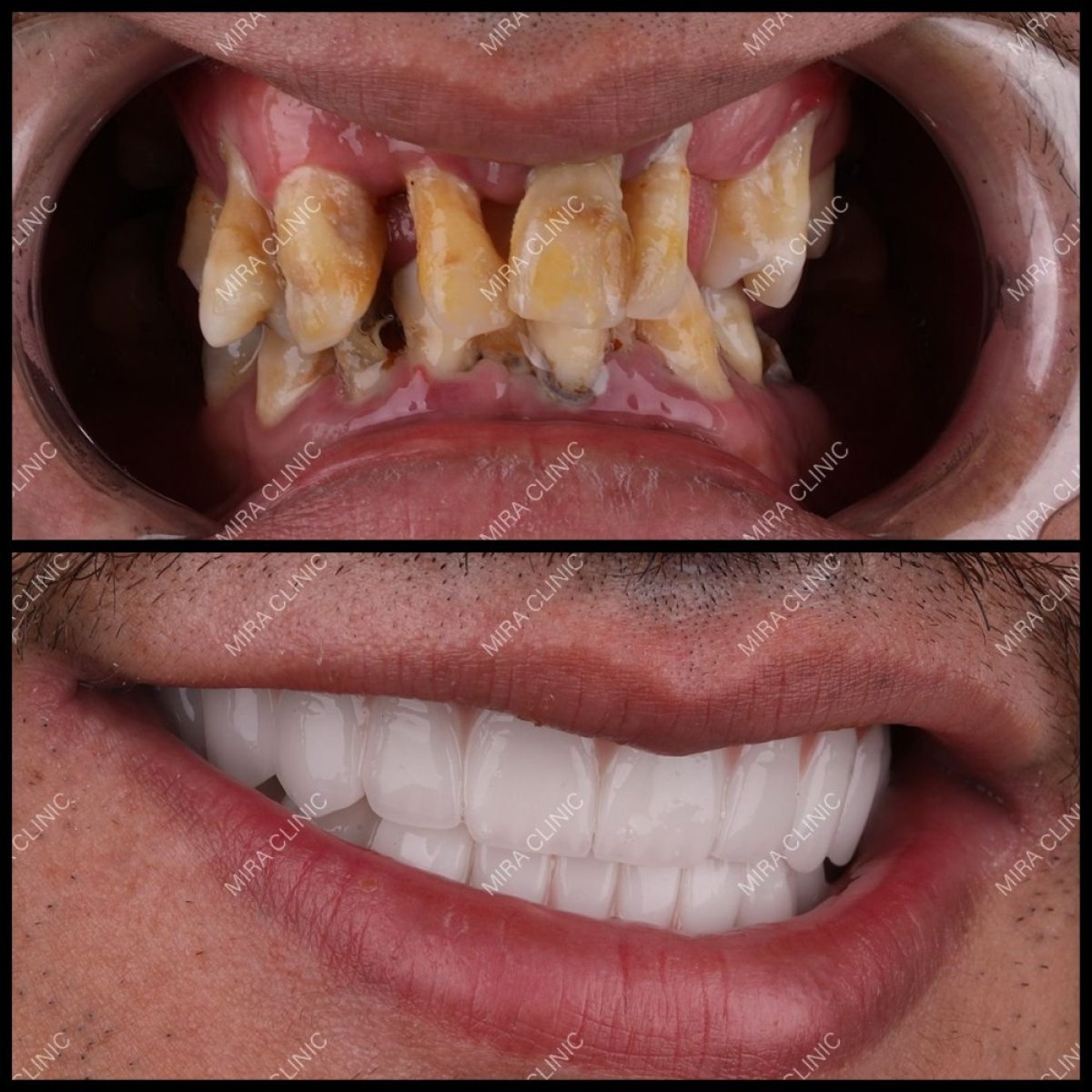 Resultados antes y después de implantes dentales en Dental Clinic Mira Clinic SAĞLIK TURİZM ŞİRKETİ