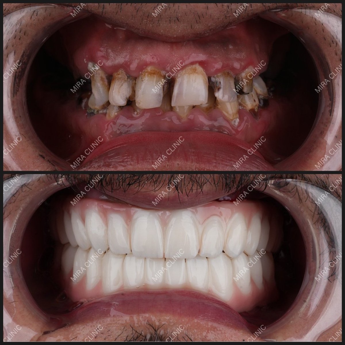 Resultado antes y después de implantes dentales All-on-4 en Dental Clinic Mira Clinic SAĞLIK TURİZM ŞİRKETİ
