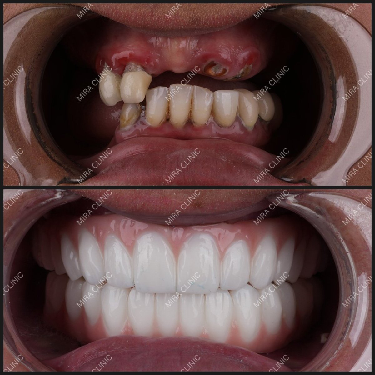Resultados antes y después de implantes All-on-4 en Dental Clinic Mira Clinic SAĞLIK TURİZM ŞİRKETİ