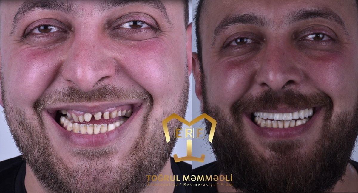 before and after photo