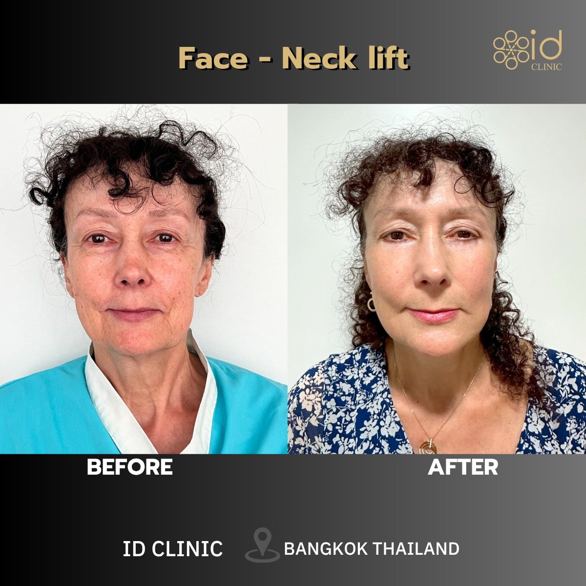 نتائج قبل وبعد شد الوجه والرقبة المصغر في ID Clinic Bangkok، تجديد ملحوظ