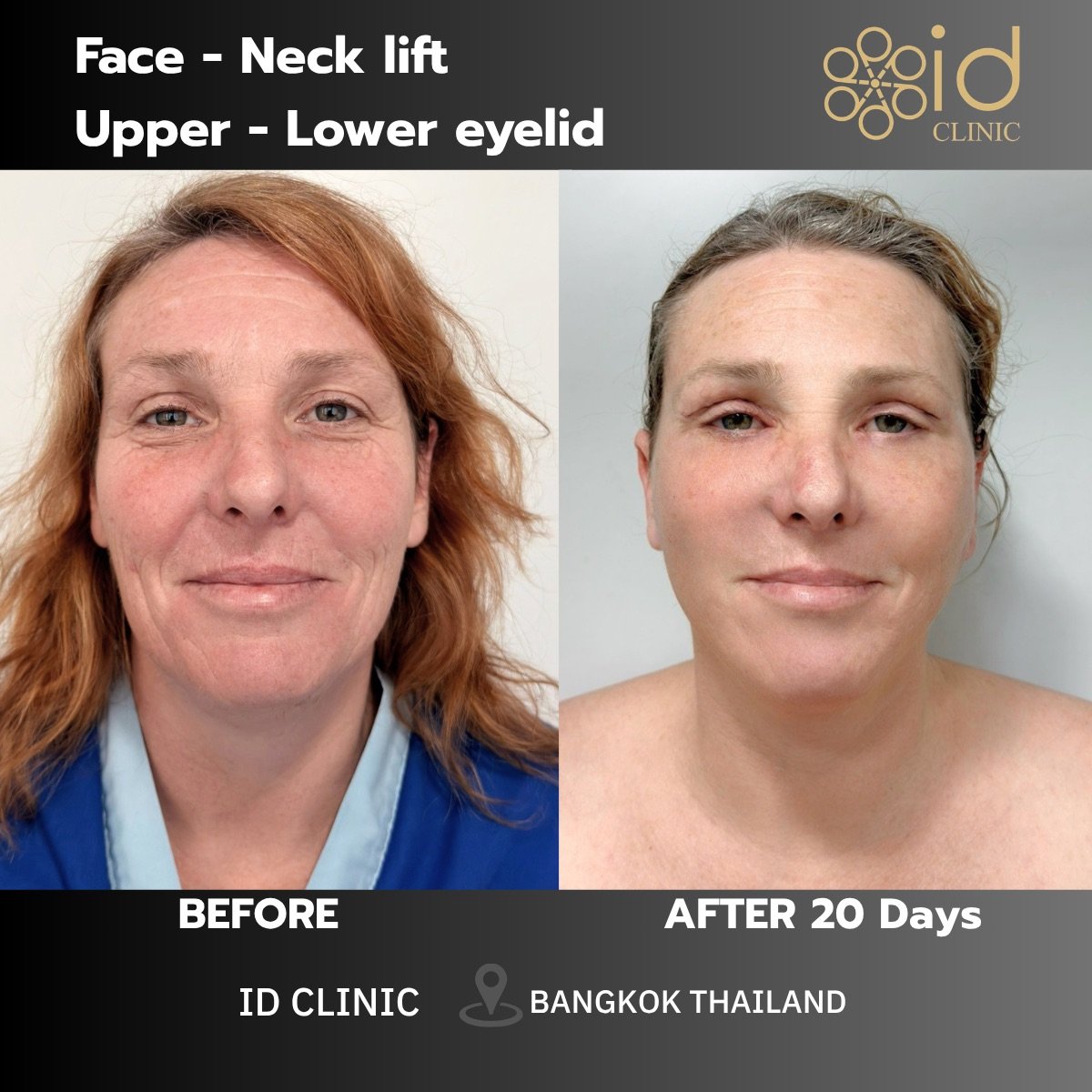 نتائج شد الوجه والرقبة وجراحة الجفون قبل وبعد في ID Clinic Bangkok