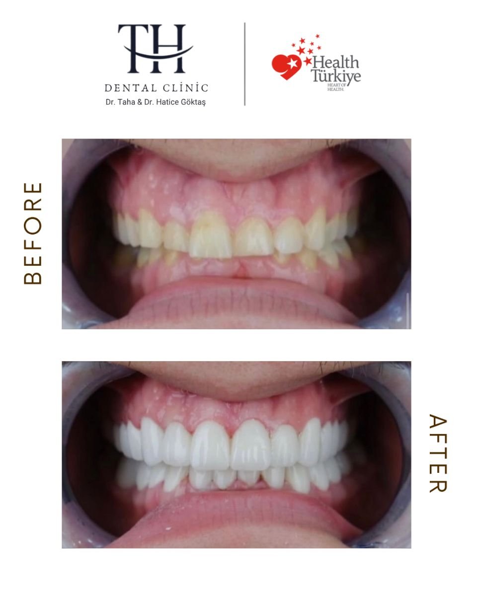 Resultados antes y después de coronas de zirconio en TH Dental Clinic – transformación de sonrisa