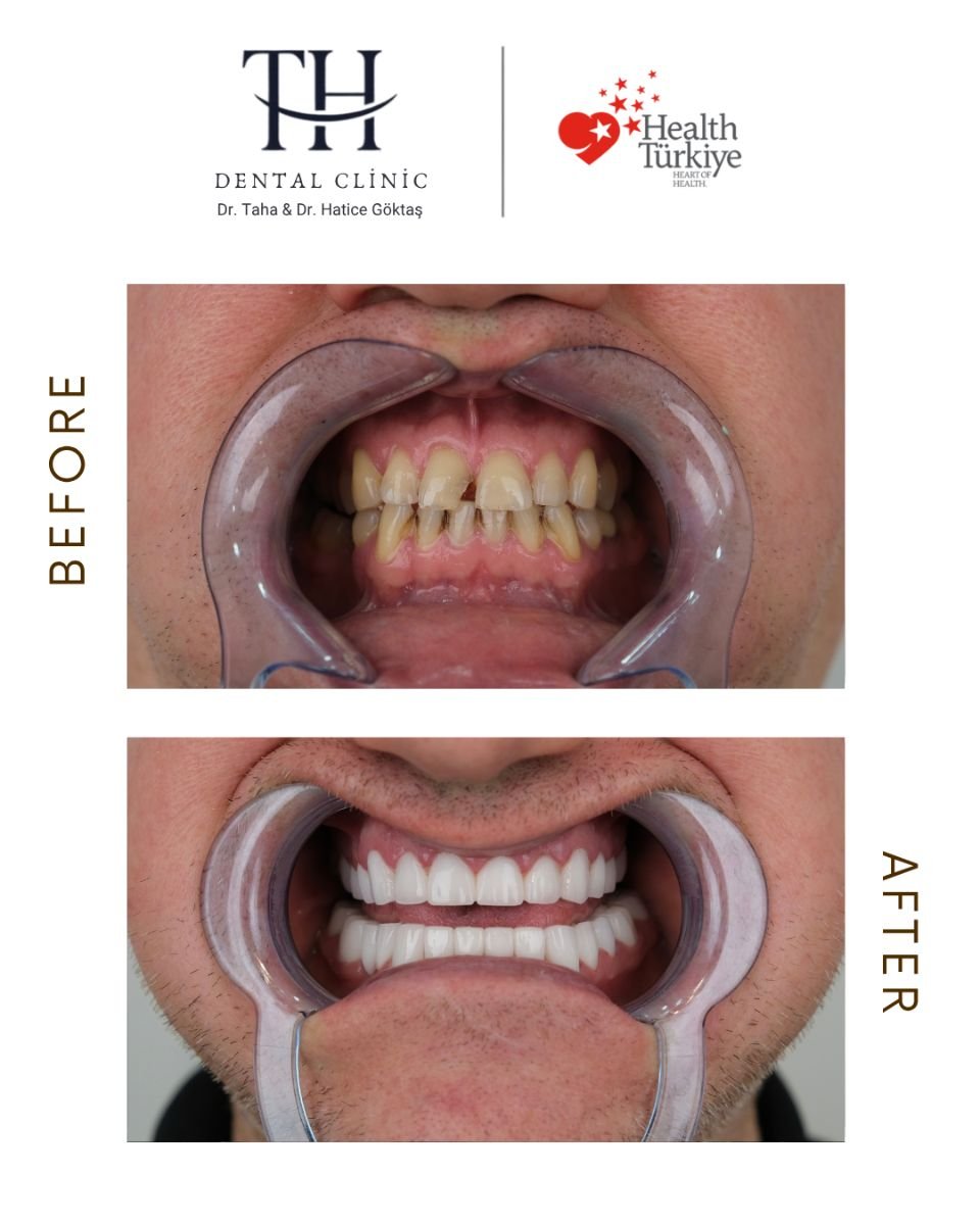Resultados antes y después de coronas de zirconia en TH Dental Clinic – restauración de sonrisa