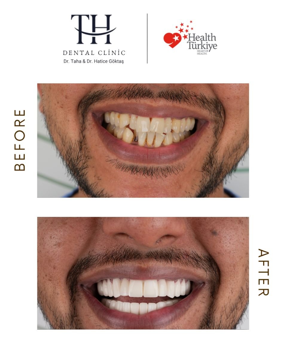 Resultados antes y después de coronas de zirconio en TH Dental Clinic – sonrisa más blanca