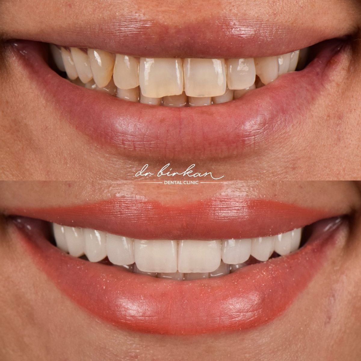 نتائج قبل وبعد تركيب تيجان الزركونيا في DR. BİRKAN DURAS CLINIC، تحول الابتسامة