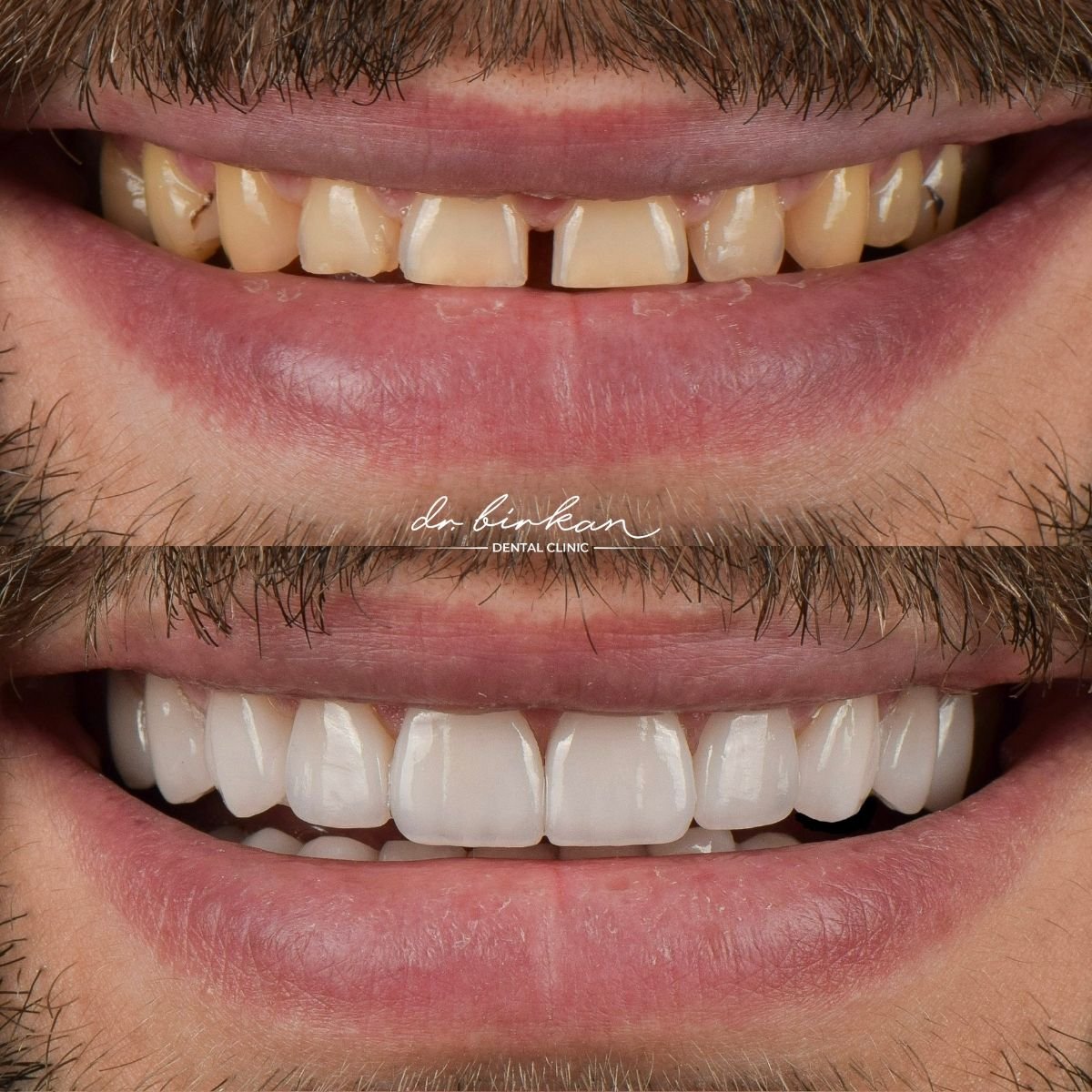 نتائج قبل وبعد تركيب تيجان الزركونيا في DR. BİRKAN DURAS CLINIC، تحسين الابتسامة