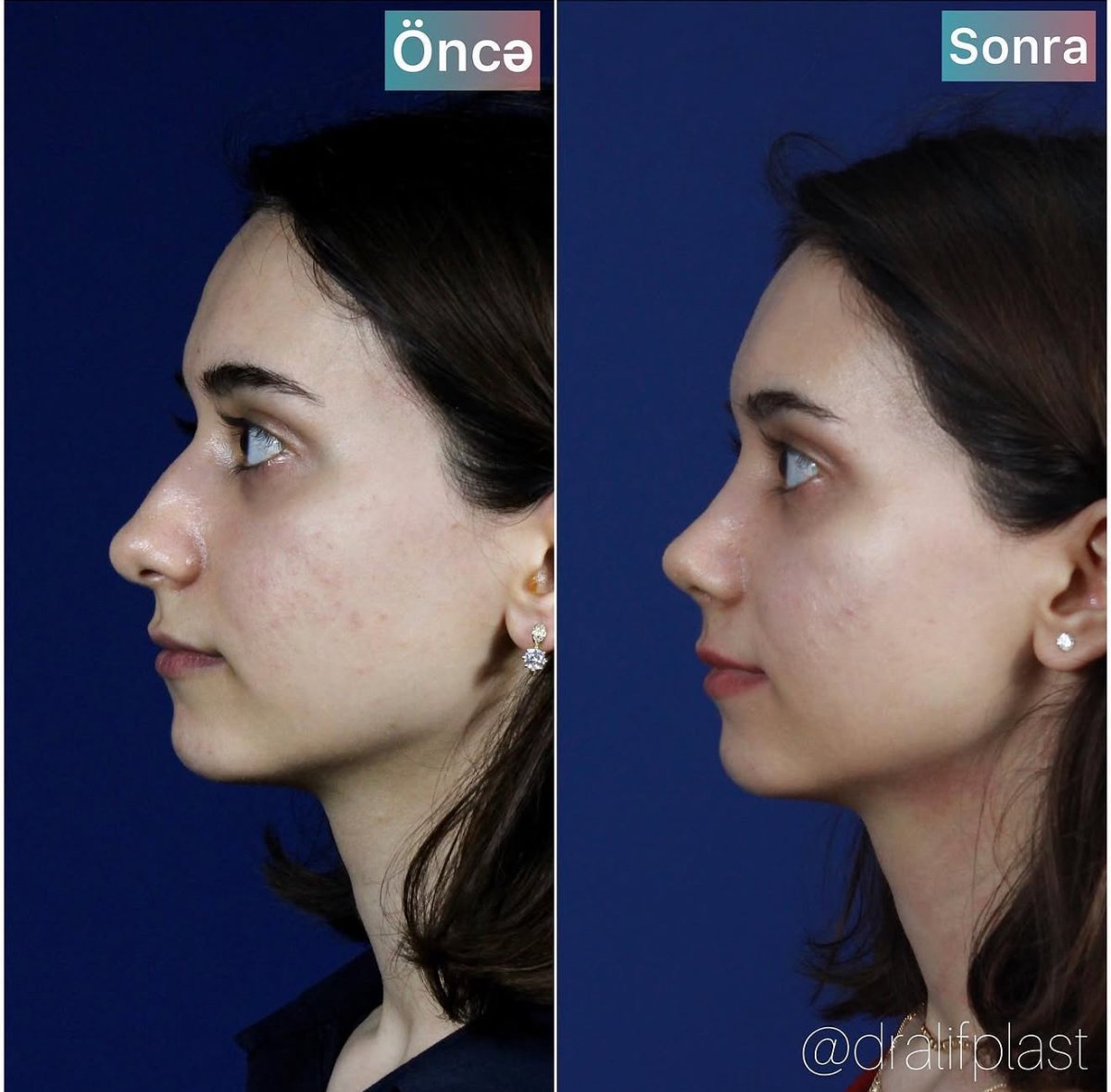 before and after photo