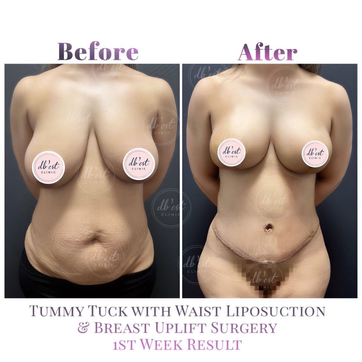 Before and after tummy tuck, waist liposuction, and breast uplift results at Db'est Clinic