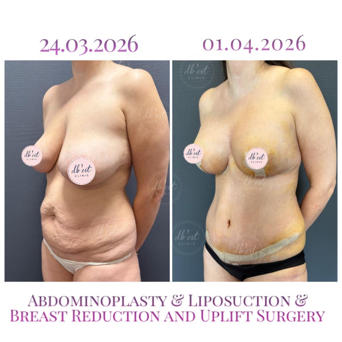 Before and after abdominoplasty, liposuction, and breast uplift results at Db'est Clinic