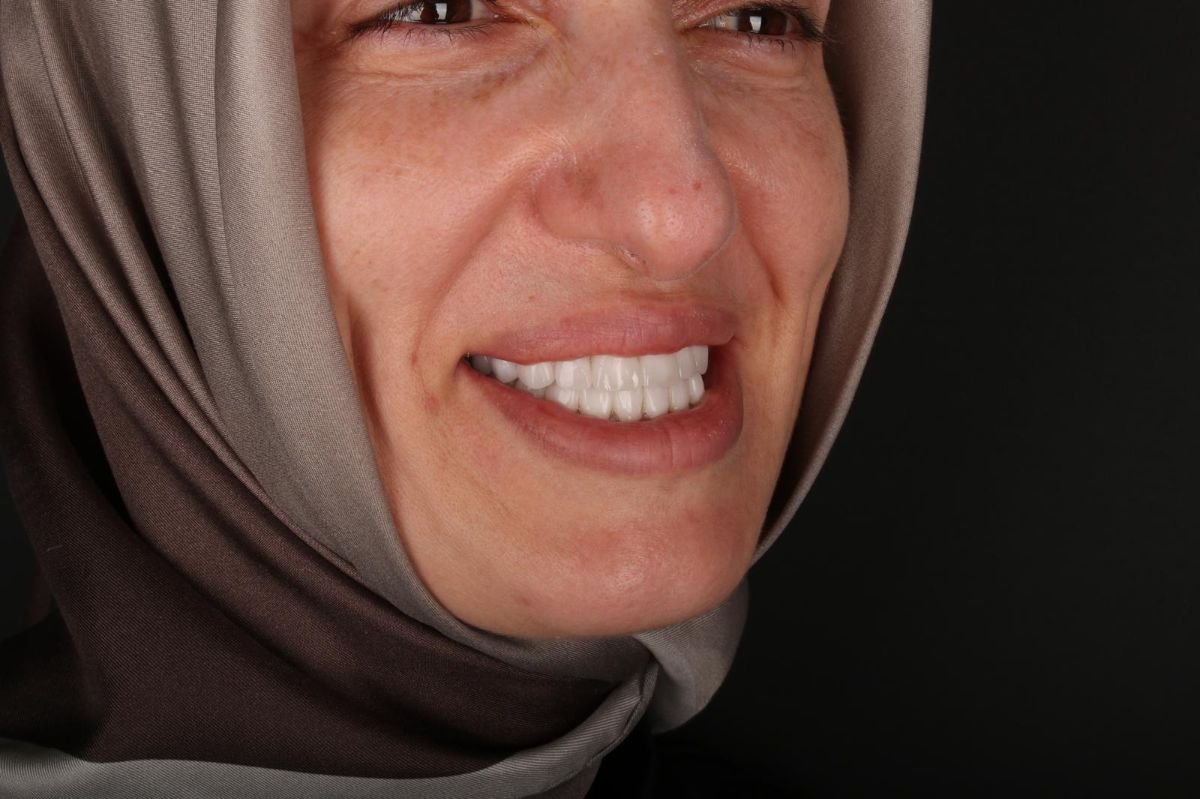 نتيجة زراعة الأسنان All-on-6 – ابتسامة مستعادة وأسنان طبيعية بعد الإجراء