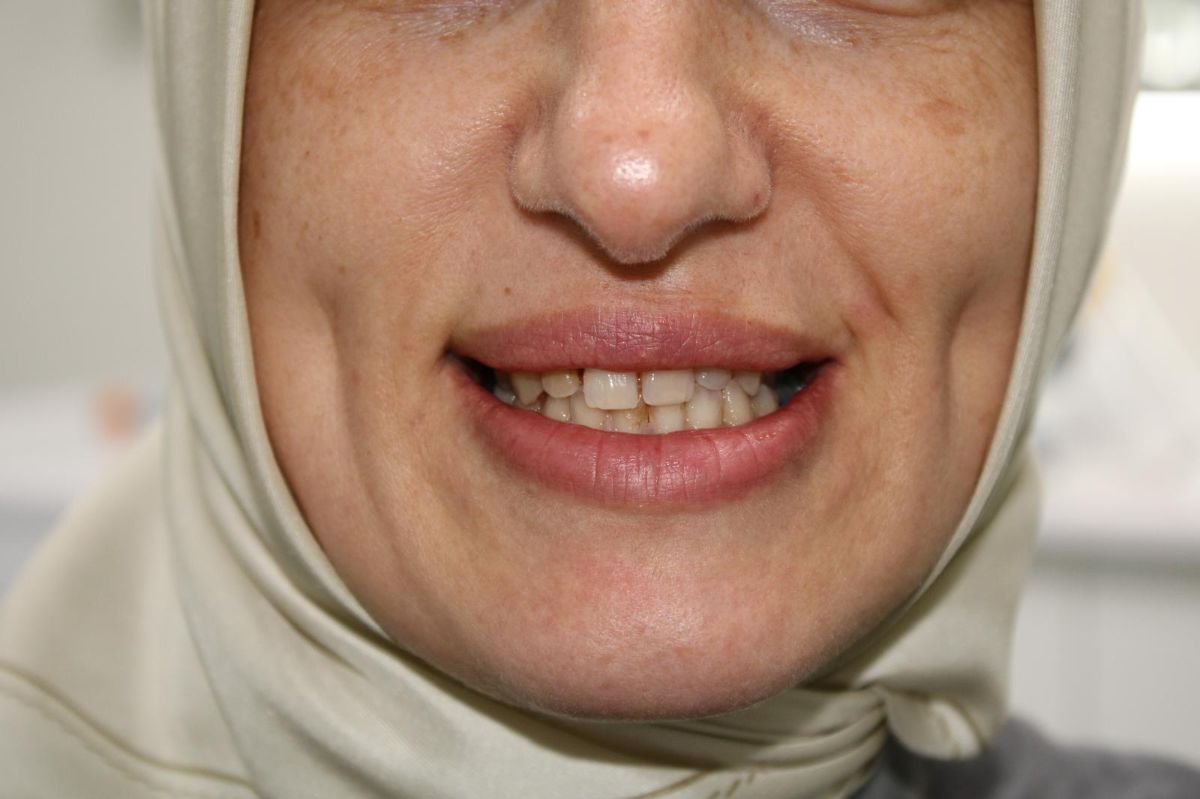 قبل زراعة الأسنان All-on-6 في العيادة – تظهر أسنان مفقودة وملونة