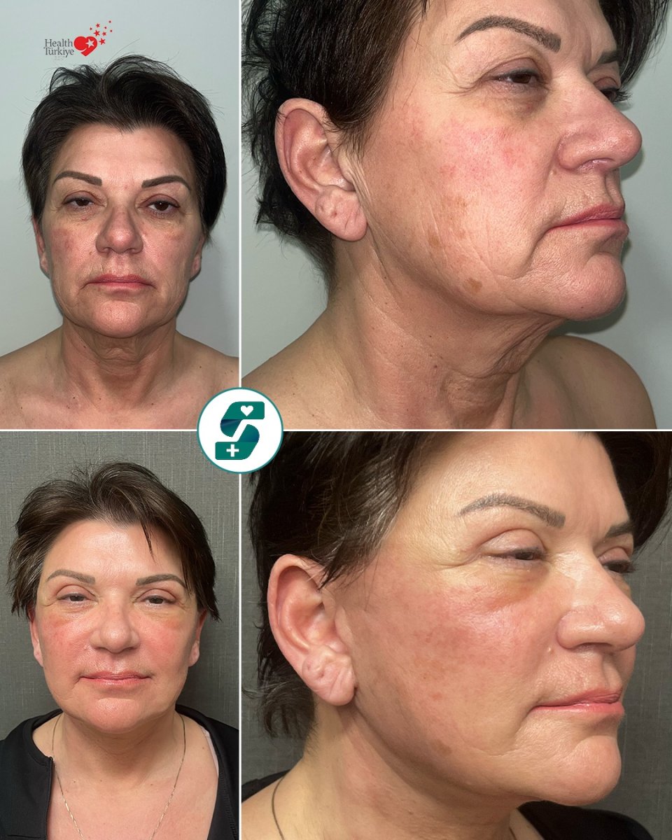 before and after photo