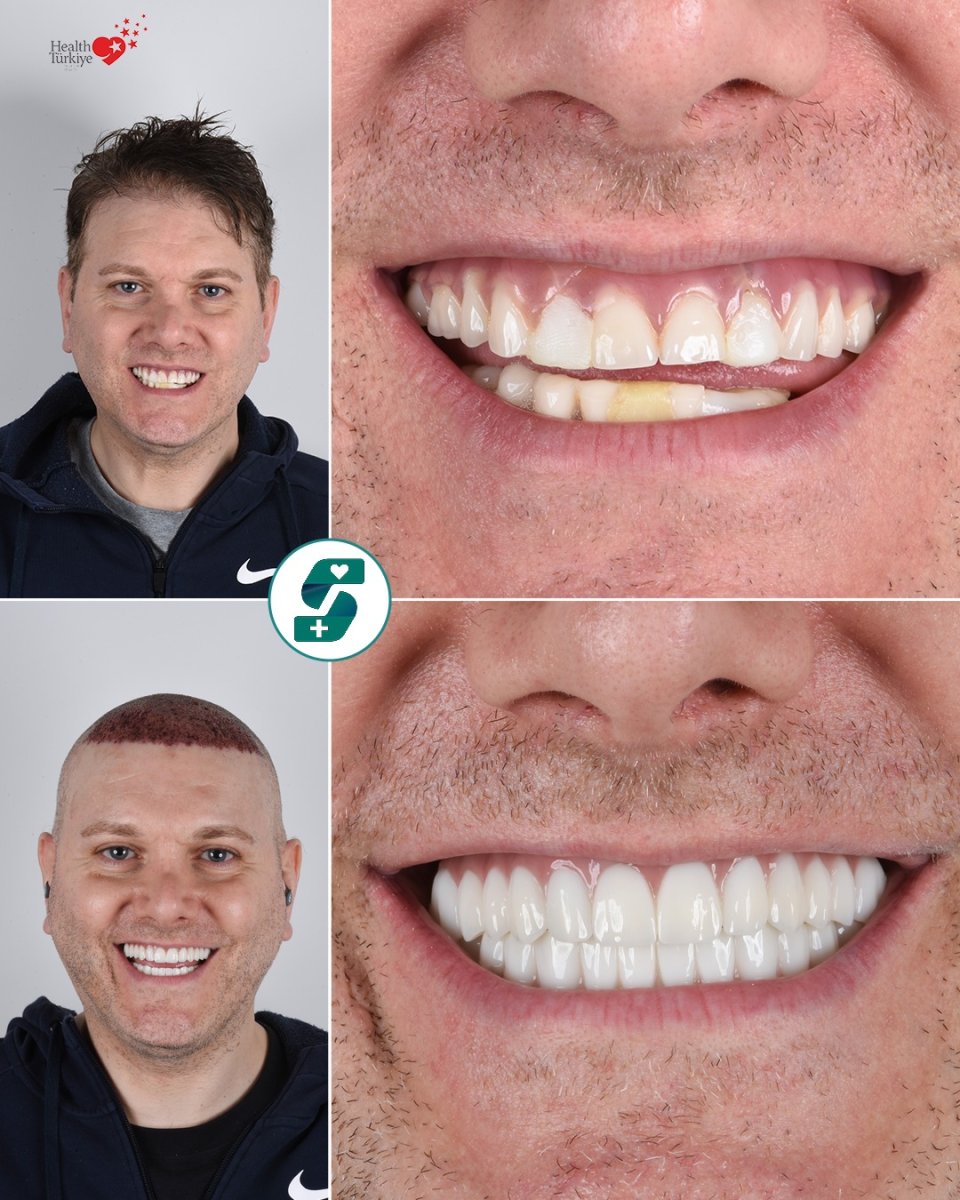 قبل وبعد تركيب تيجان الزركونيا في Soraca Med – نتائج تجميل الابتسامة