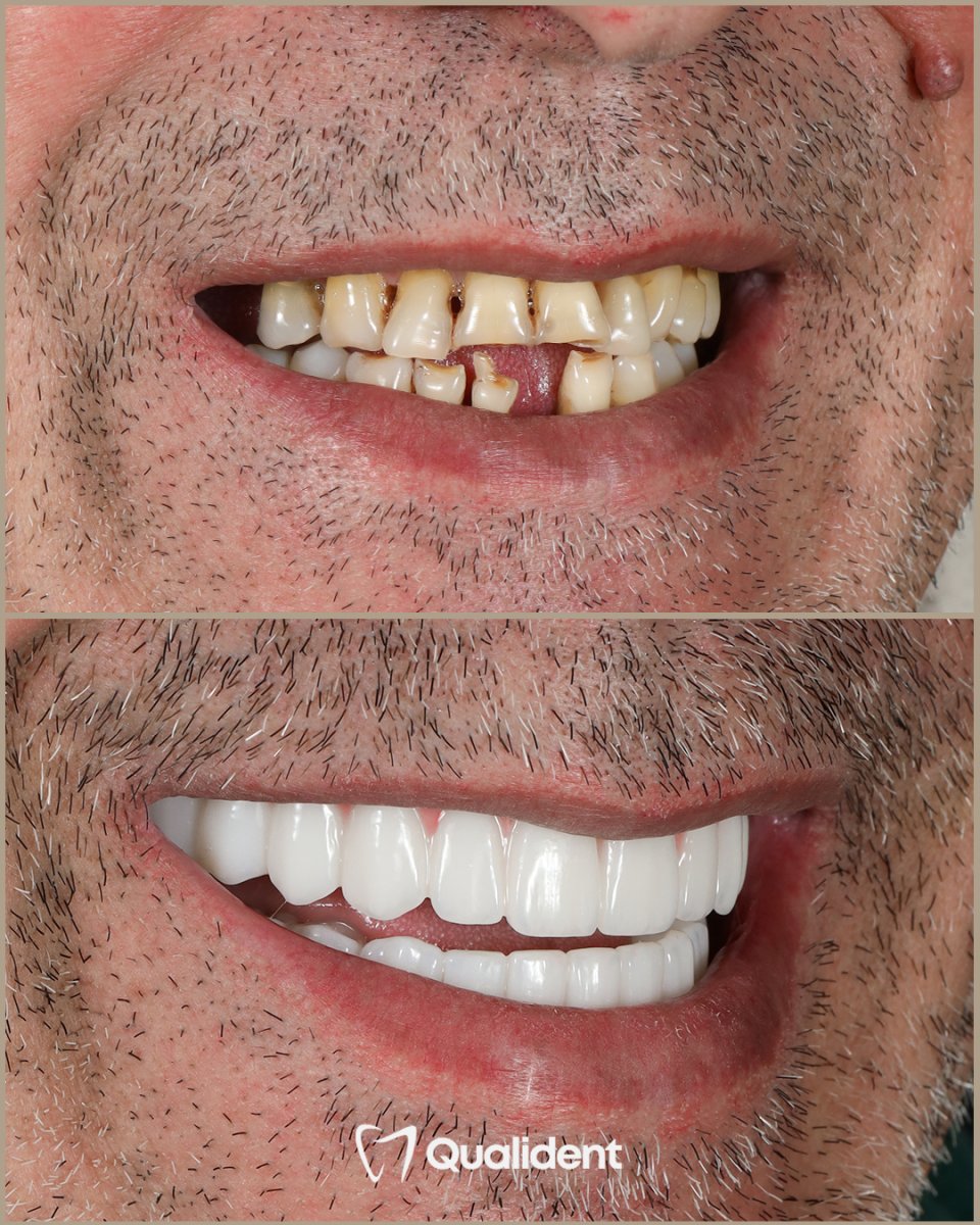 before and after photo