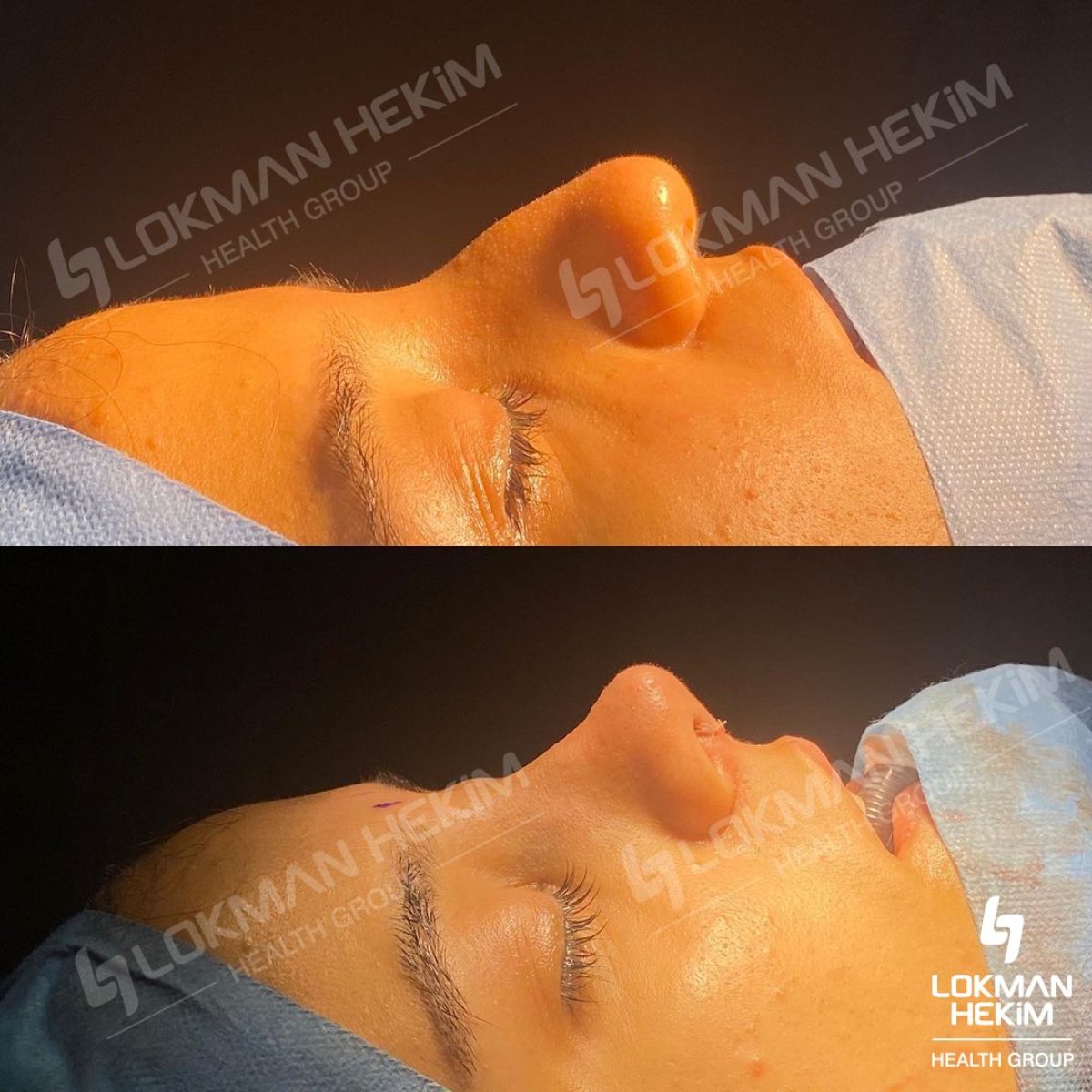 Результаты до и после риносептопластики в Lokman Hekim Istanbul Hospital, коррекция носа