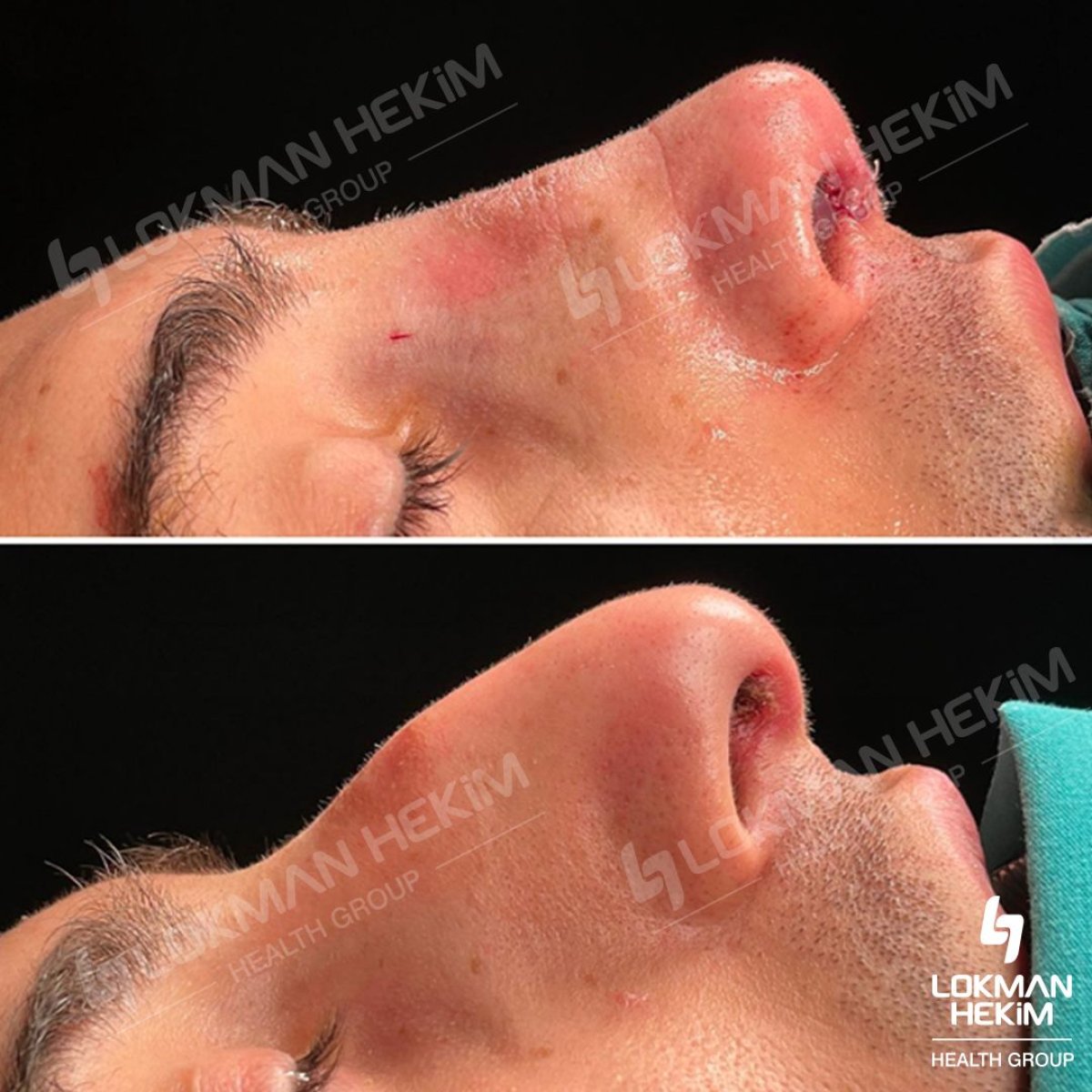 Resultados antes y después de rinoplastia ultrasónica en Lokman Hekim Istanbul Hospital, remodelación nasal