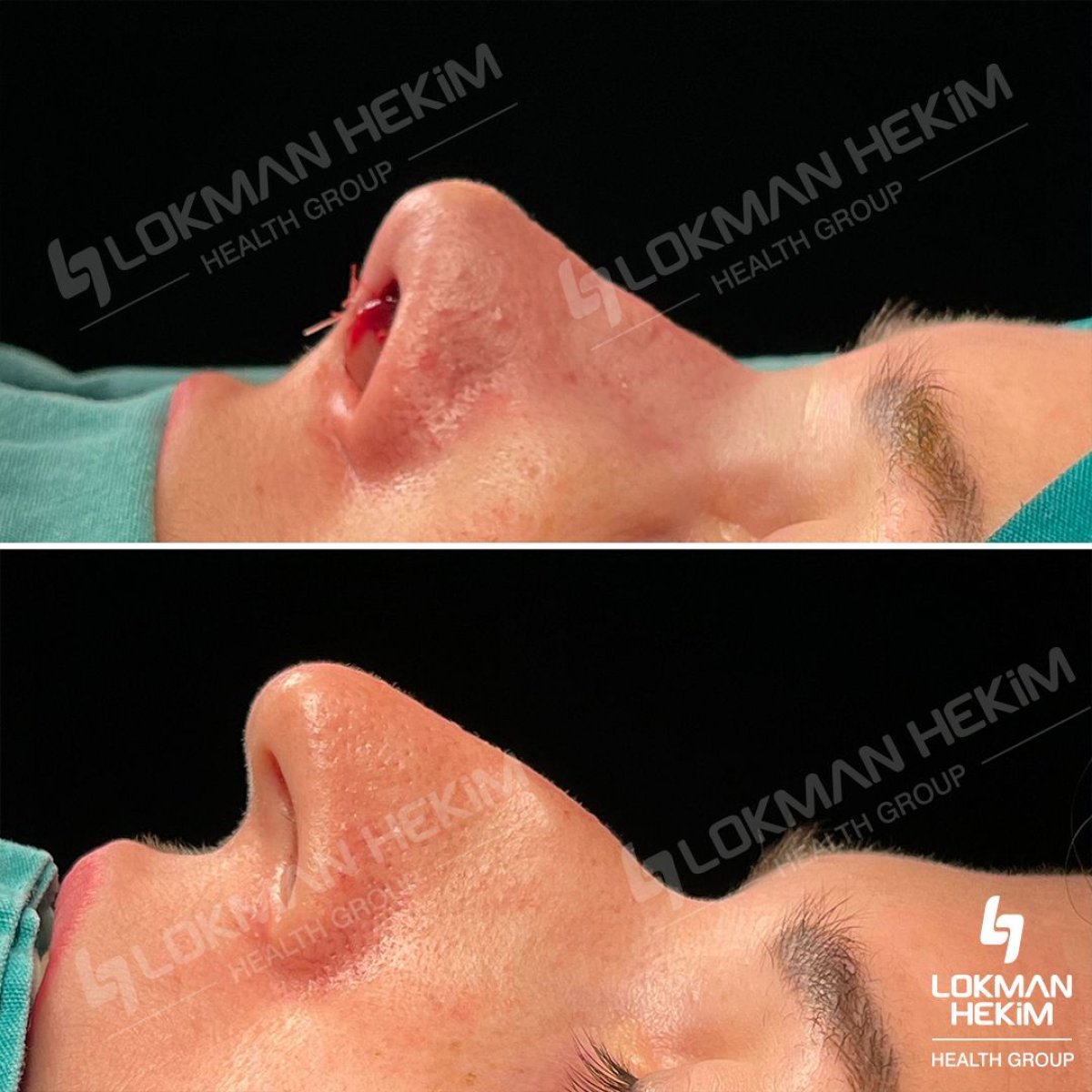 Resultados antes y después de rinoplastia ultrasónica en Lokman Hekim Istanbul Hospital, remodelación nasal