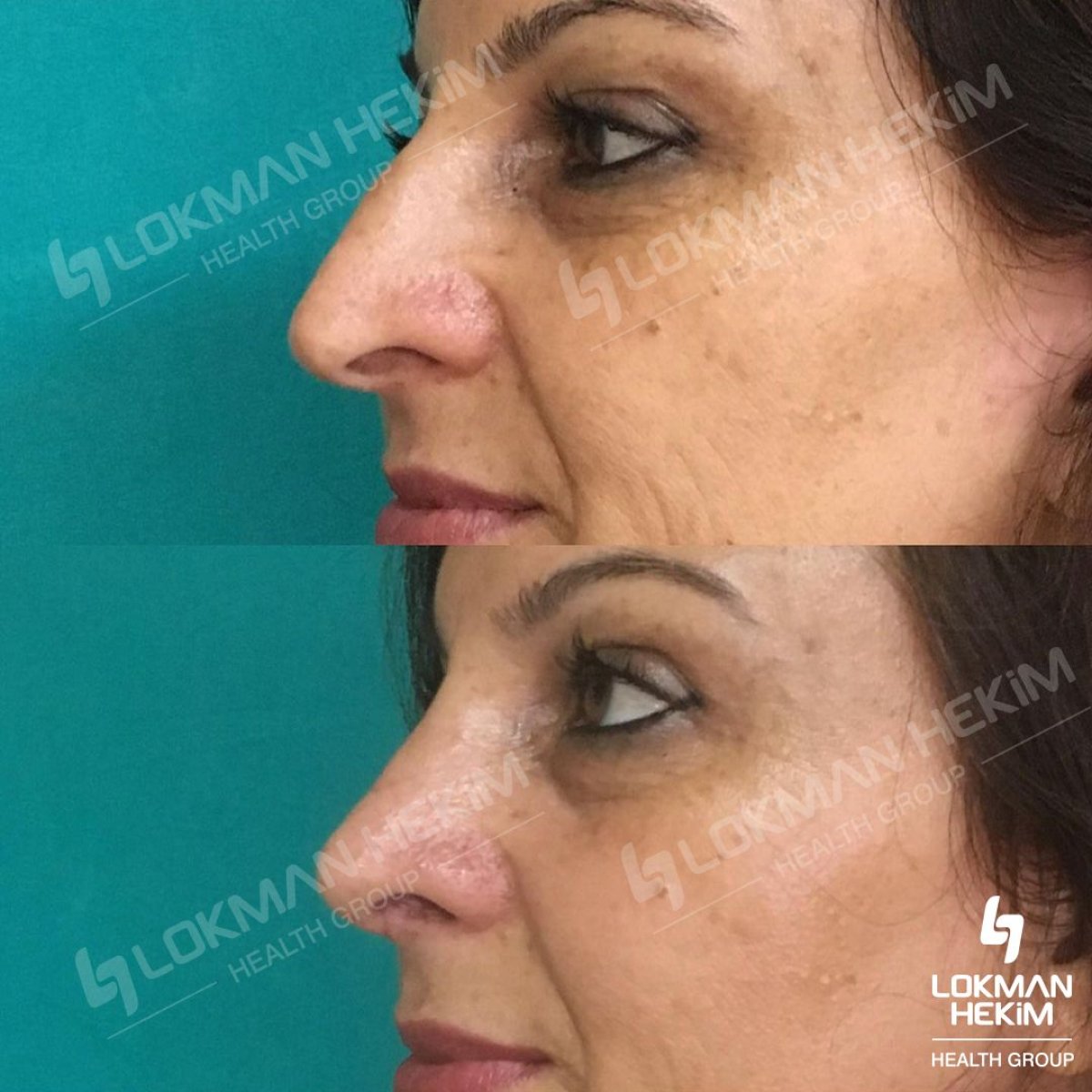 Resultados antes y después de rinoplastia ultrasónica en Lokman Hekim Istanbul Hospital