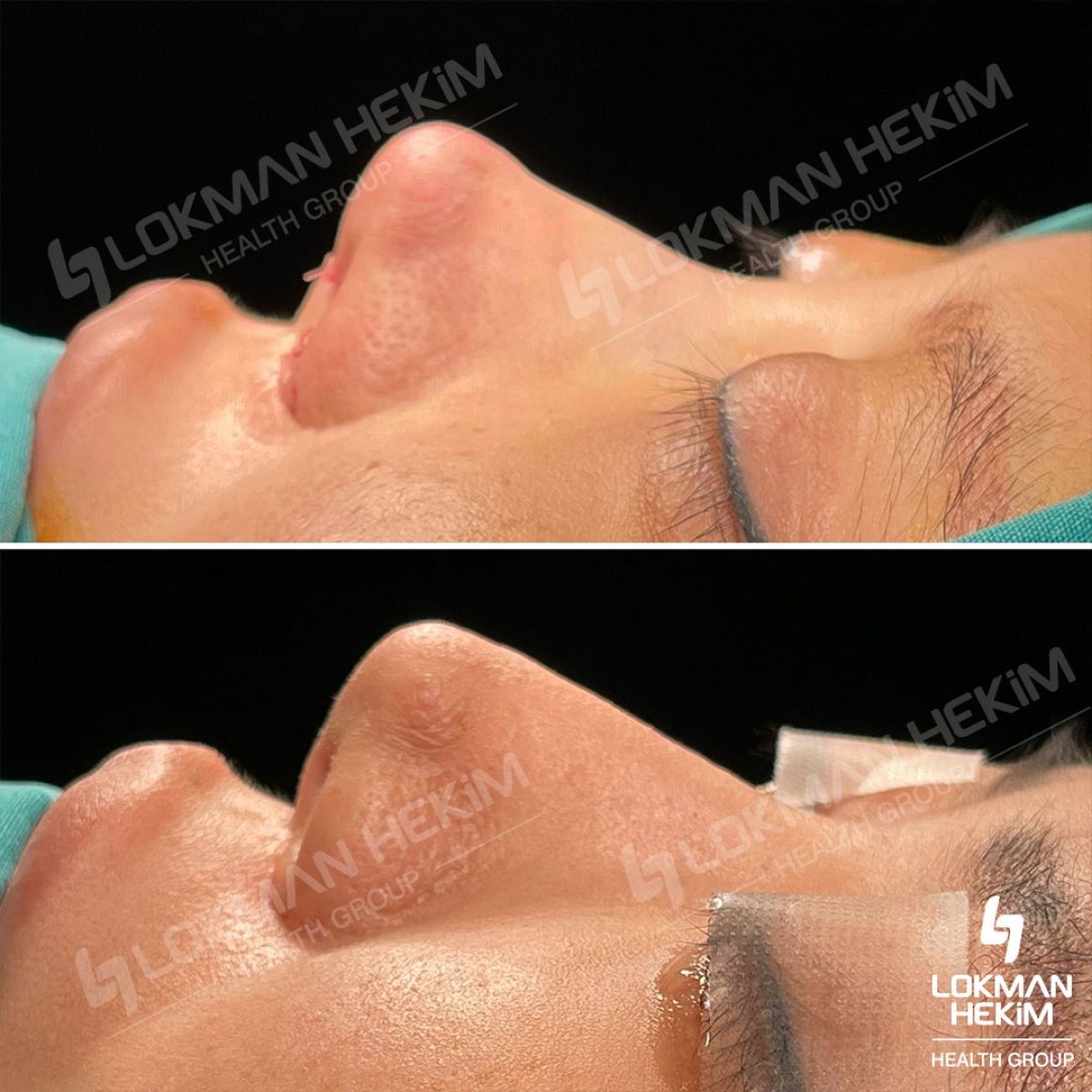 Resultados antes y después de rinoplastia ultrasónica en Lokman Hekim Istanbul Hospital