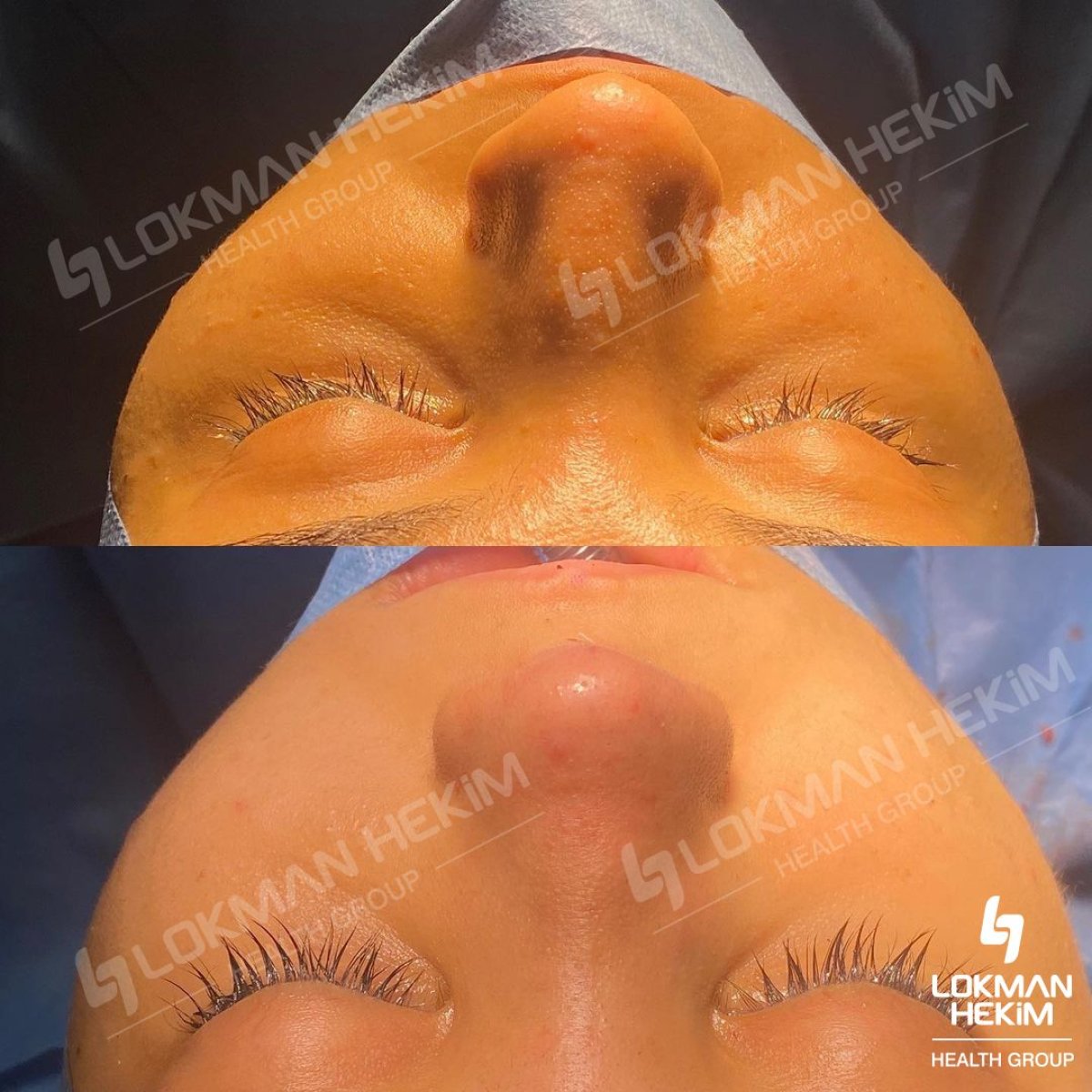 Resultados antes y después de rinoplastia ultrasónica en Lokman Hekim Istanbul Hospital, remodelación nasal