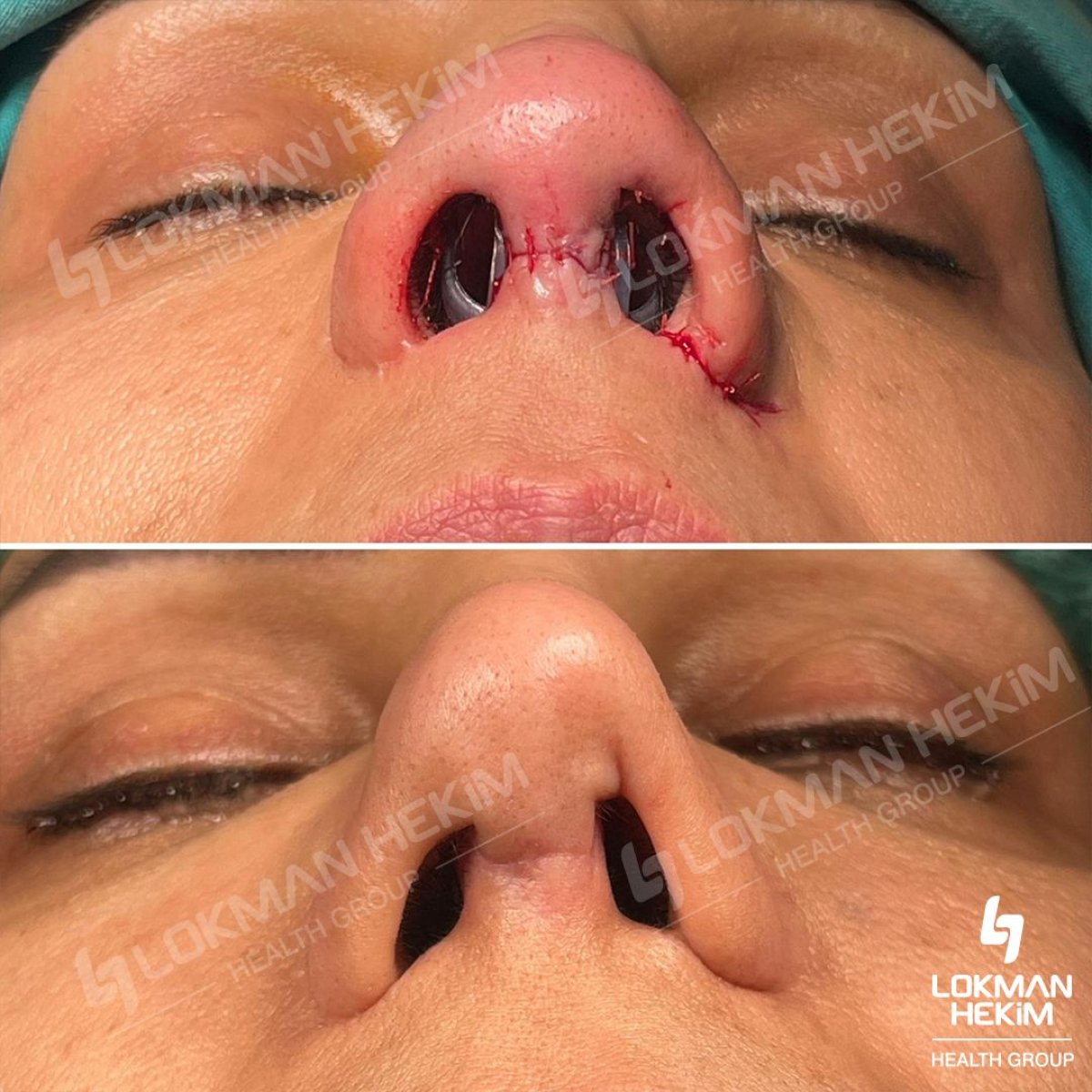 Resultados antes y después de rinoplastia ultrasónica en Lokman Hekim Istanbul Hospital, remodelación nasal