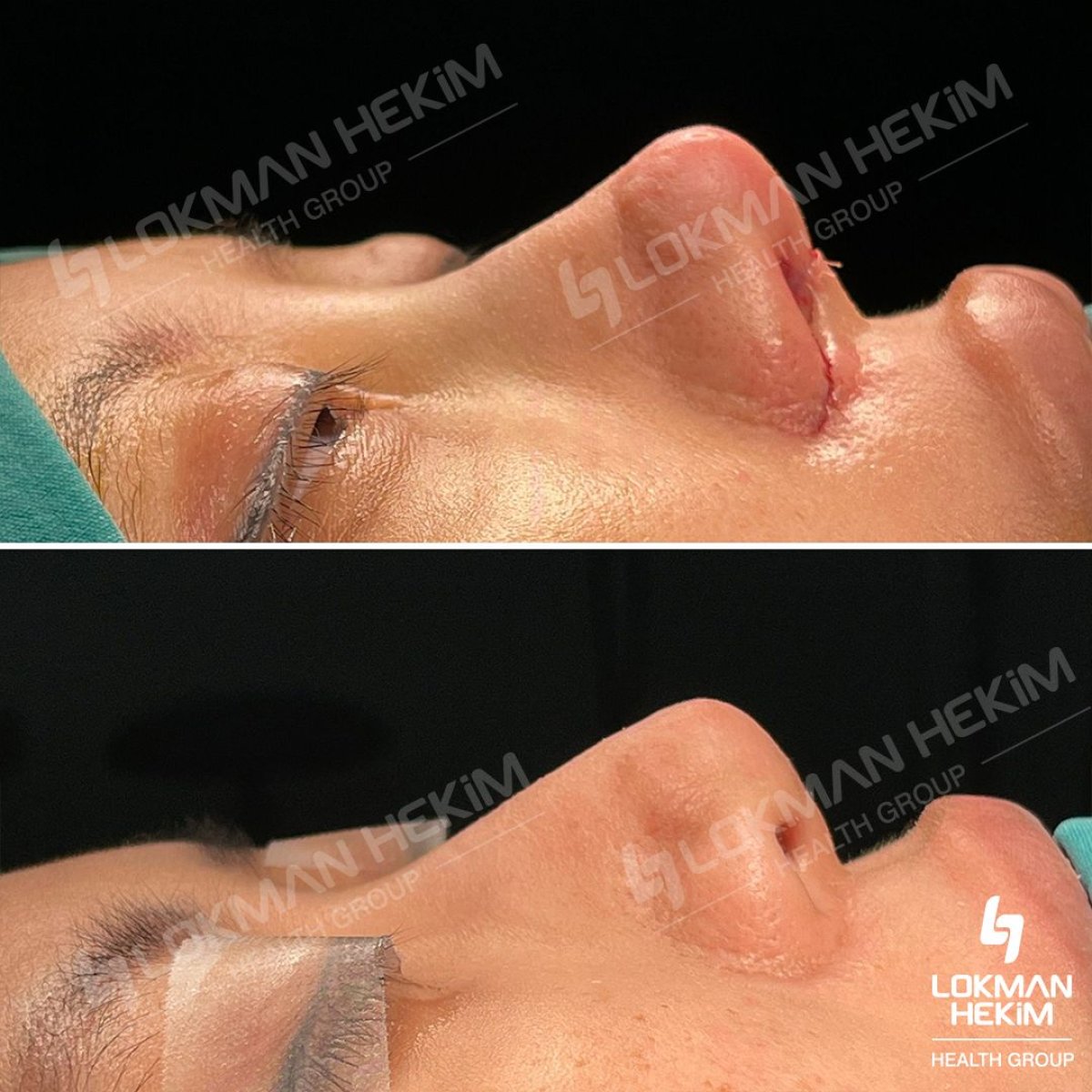 Resultados antes y después de rinoplastia ultrasónica en Lokman Hekim Istanbul Hospital