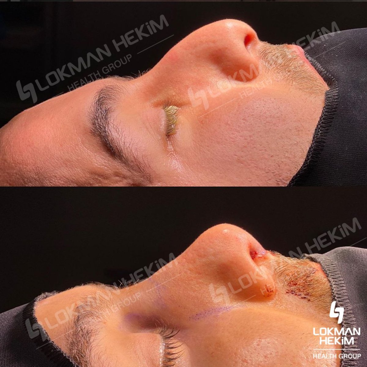 Resultados antes y después de rinoplastia ultrasónica en Lokman Hekim Istanbul Hospital