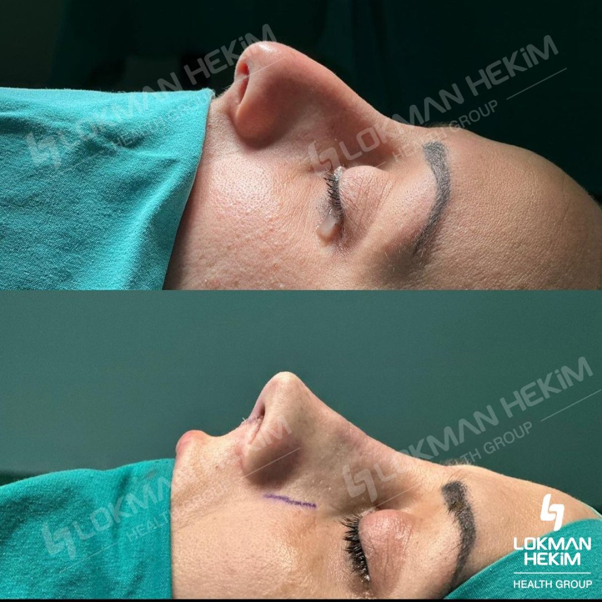 Resultados antes y después de rinoplastia ultrasónica en Lokman Hekim Istanbul Hospital, remodelación nasal
