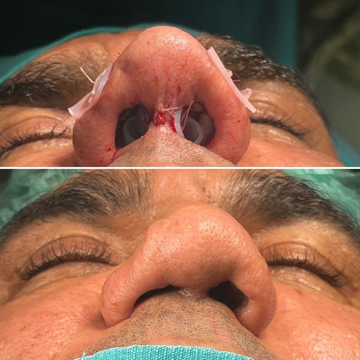 Resultados de rinoplastia de revisión antes y después en Lokman Hekim Istanbul Hospital, mejora nasal