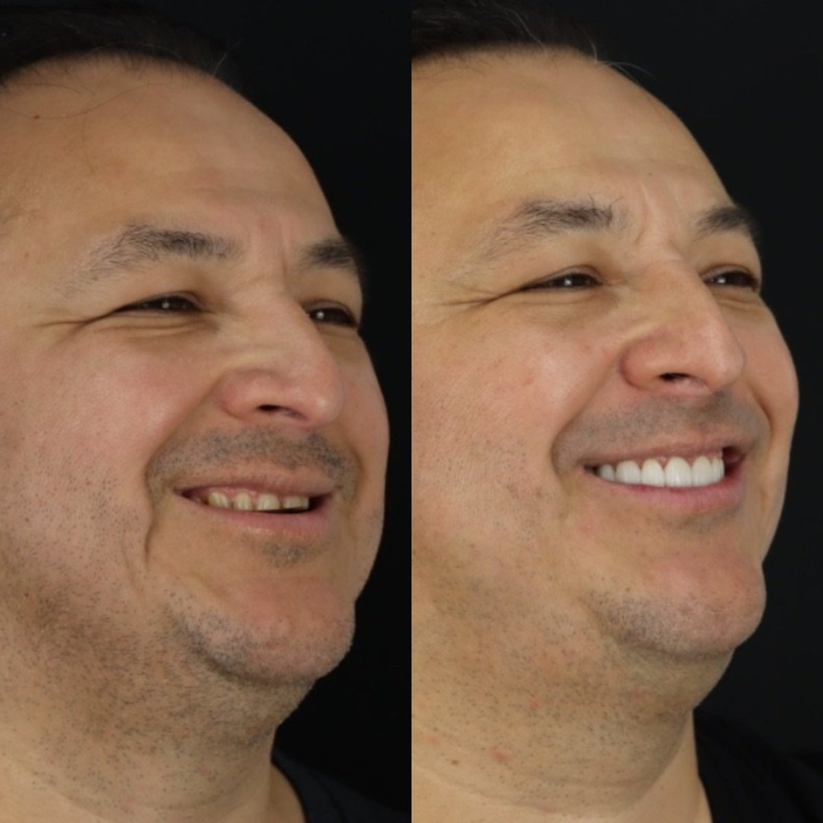 Resultados antes y después de coronas de porcelana en Smile 4 Ever Mexico, sonrisa mejorada