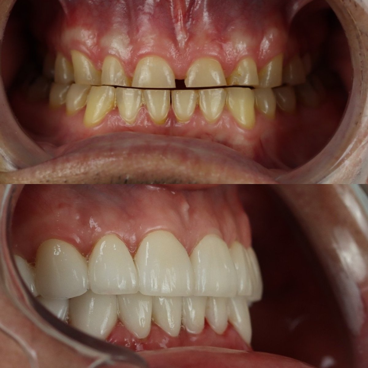 Resultados antes y después de coronas de porcelana en Smile 4 Ever Mexico, restauración de sonrisa
