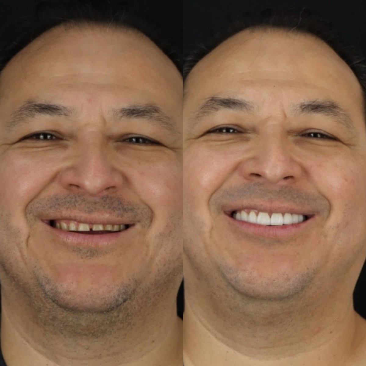 Antes y después de coronas de porcelana en Smile 4 Ever Mexico, resultado de sonrisa