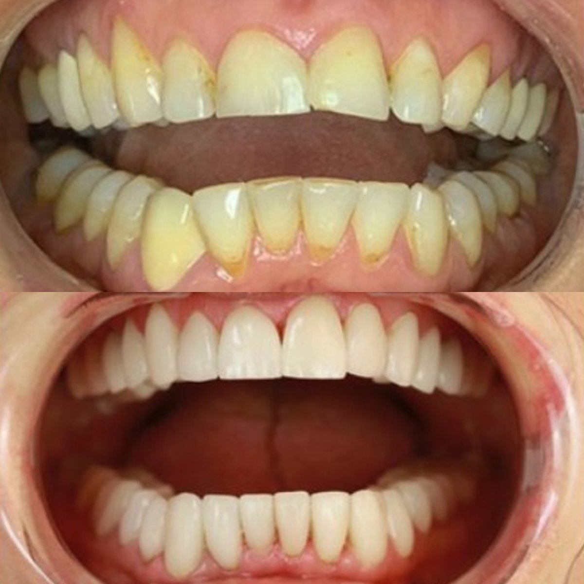 Resultados antes y después de carillas de porcelana en Smile 4 Ever Mexico – dientes blancos y parejos