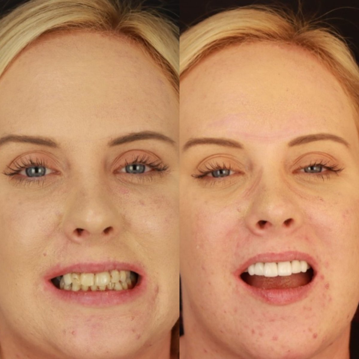 Resultados antes y después de carillas de porcelana en Smile 4 Ever Mexico, transformación visible