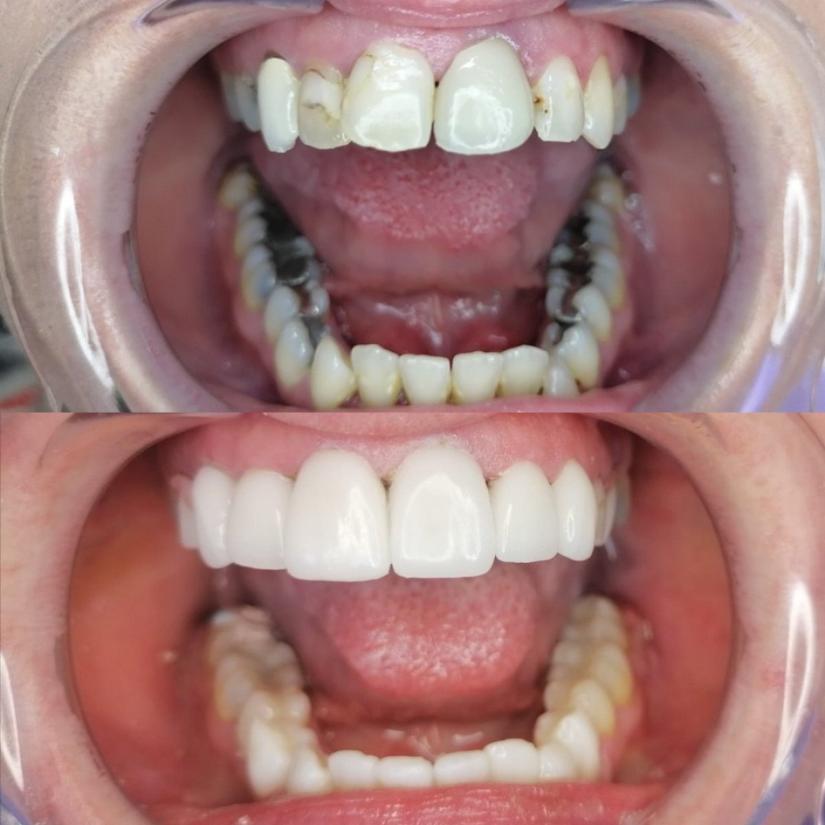Resultados antes y después de carillas de porcelana en Smile 4 Ever Mexico, transformación de sonrisa