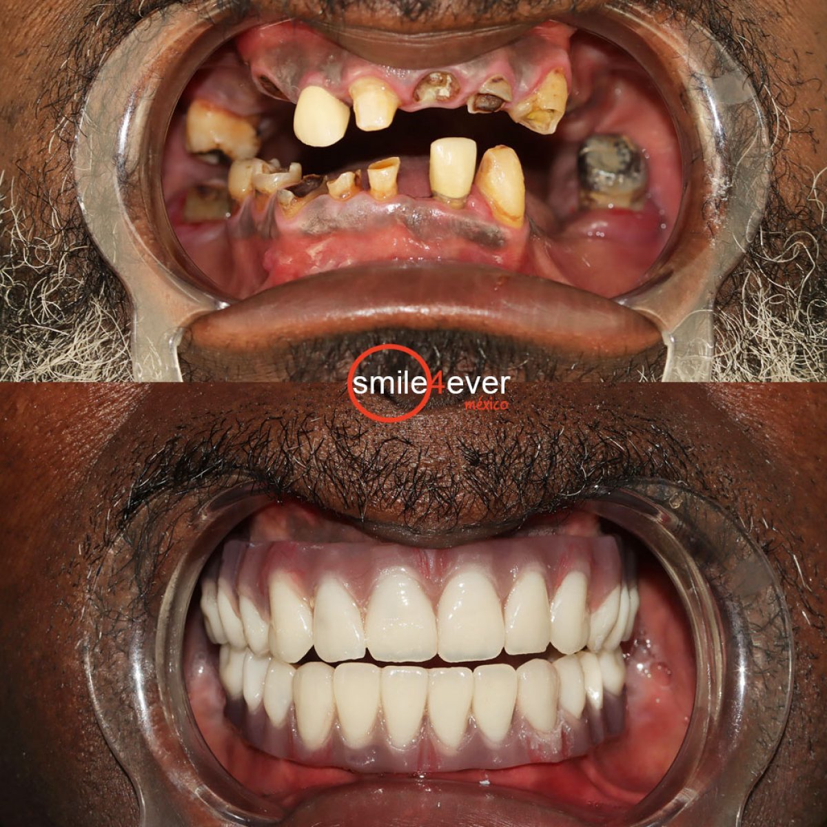 Resultados antes y después de implantes All-on-4 en Smile 4 Ever Mexico, restauración total