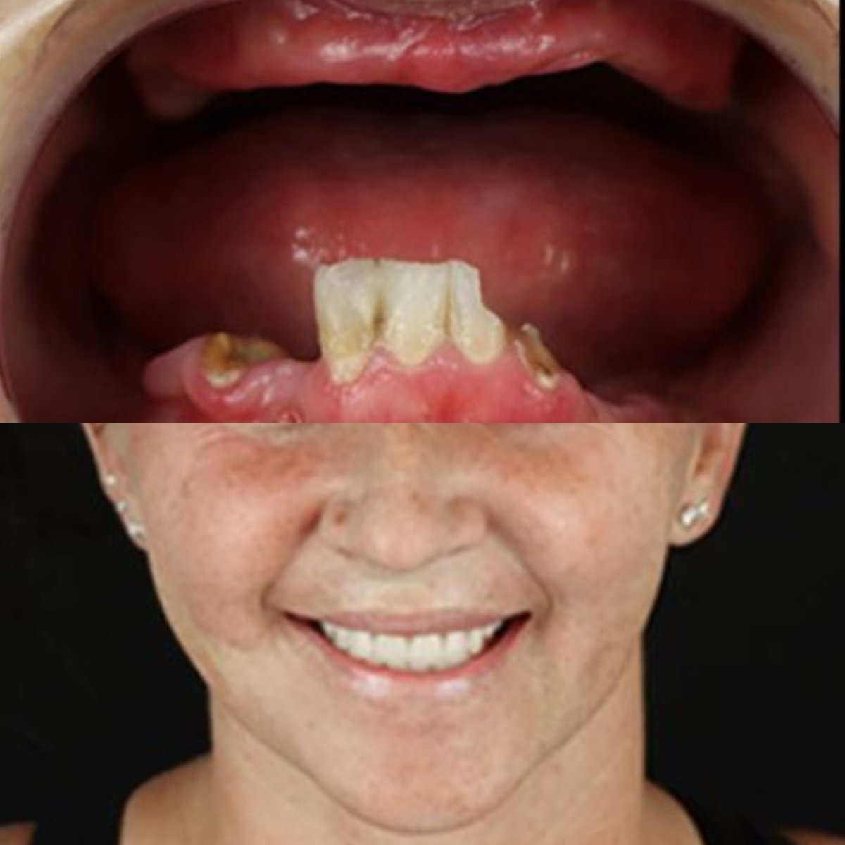 Resultados antes y después de implantes All-on-4 en Smile 4 Ever Mexico, sonrisa restaurada