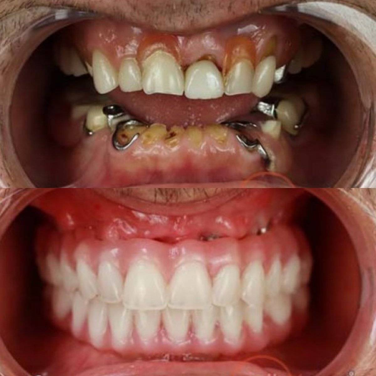 Resultados antes y después de implantes All-on-4 en Smile 4 Ever Mexico, restauración total