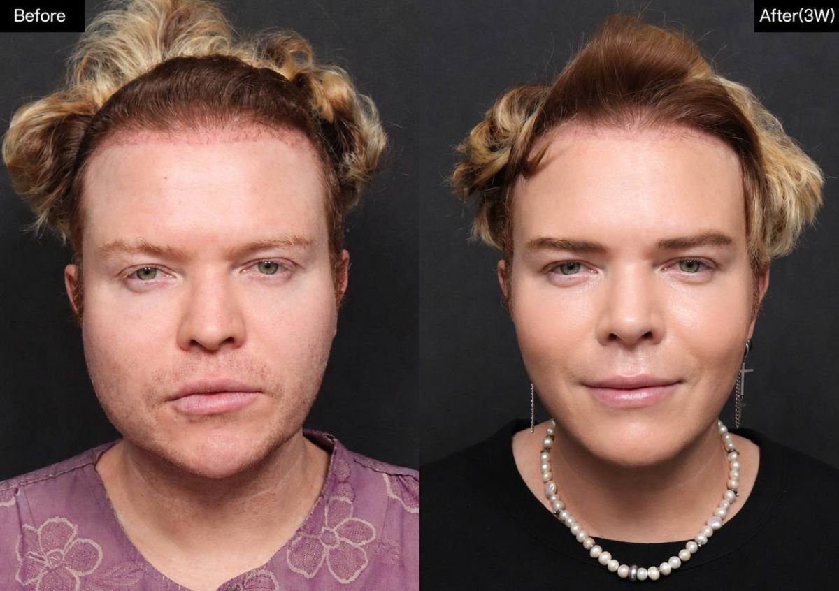 نتائج قبل وبعد تشكيل الفك في VG Plastic Surgery مع تحسين ملامح الوجه