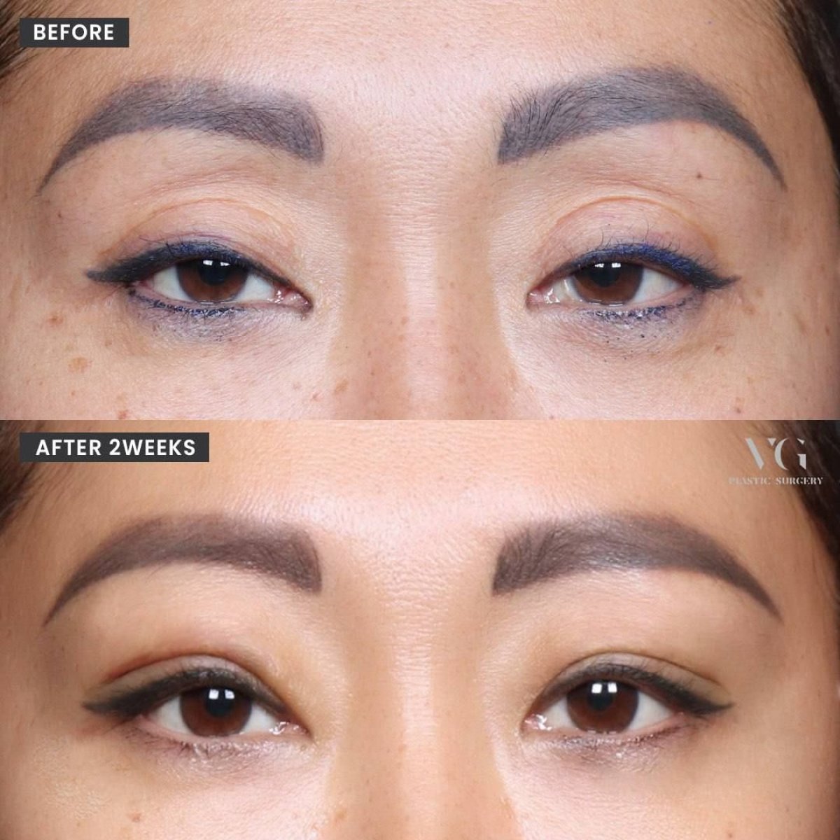 نتائج رأب الجفن قبل وبعد في VG Plastic Surgery، تصحيح الجفن بعد أسبوعين