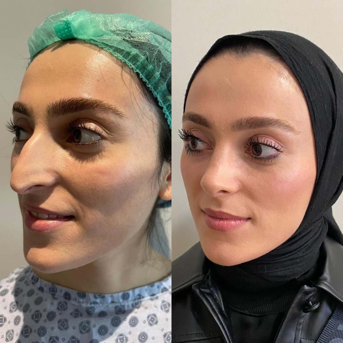 Before and after rhinoplasty results at Optimed International Hospital, refined nose shape