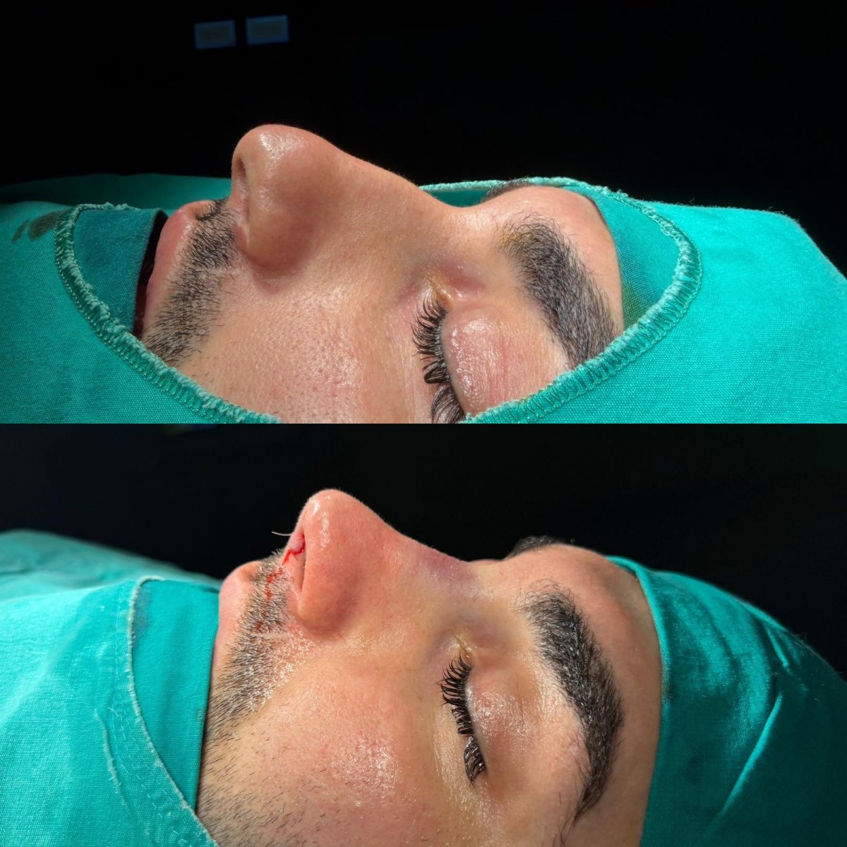 Resultados de rinoplastia antes y después en Optimed International Hospital, forma de nariz mejorada