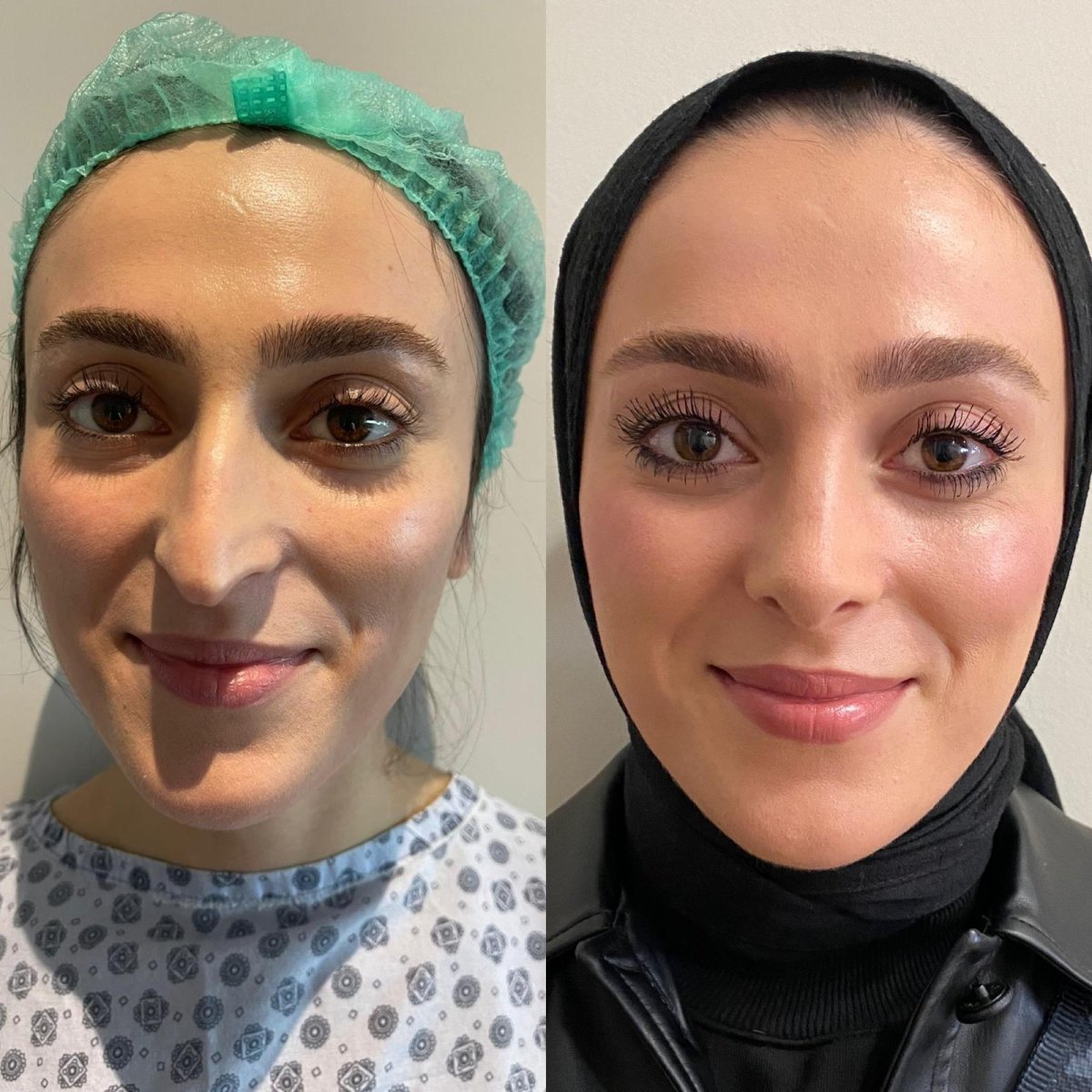Resultados de rinoplastia antes y después en Optimed International Hospital, remodelación nasal